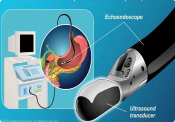 Ecoendoscopia