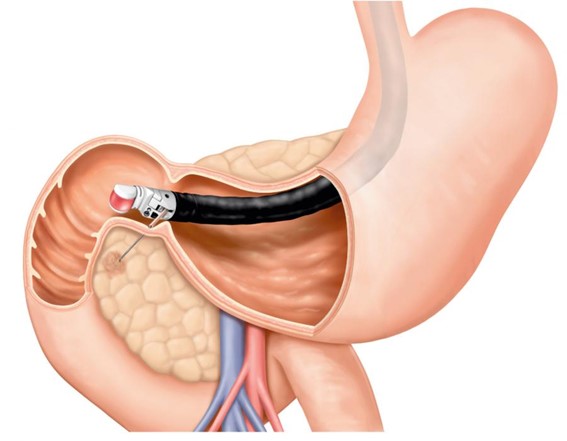 Ecoendoscopia com punção biópsia de lesão pancreática